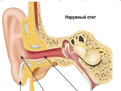 Заложенность и боль в ухе при насморке